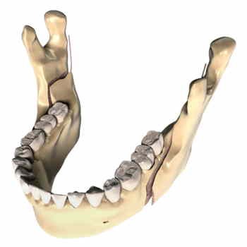 QU’EST-CE QUE L’OSTEOTOMIE DE LA MANDIBULE ?