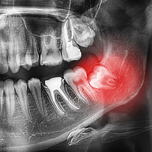 Chirurgie des dents de sagesse à Genève